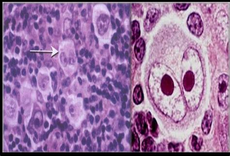 reed-sternberg cells